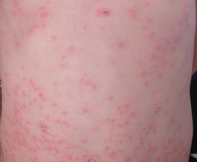 Gwent measles outbreak is over 
